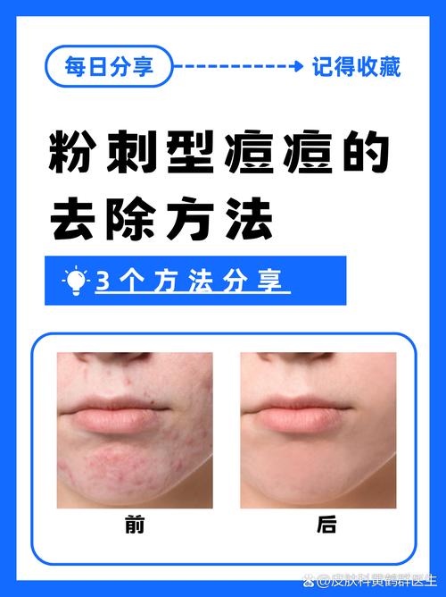 痘痘怎么去除有效果/痘痘如何祛除